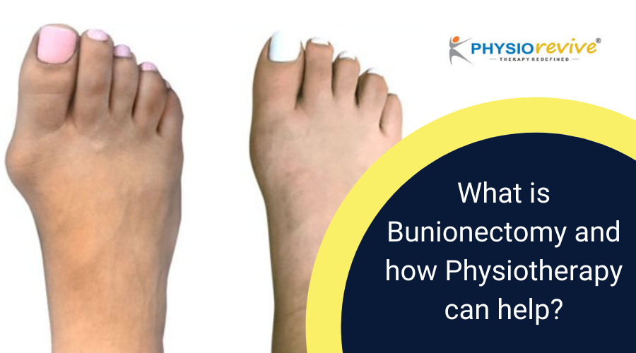 What is Bunionectomy and how Physiotherapy can help?