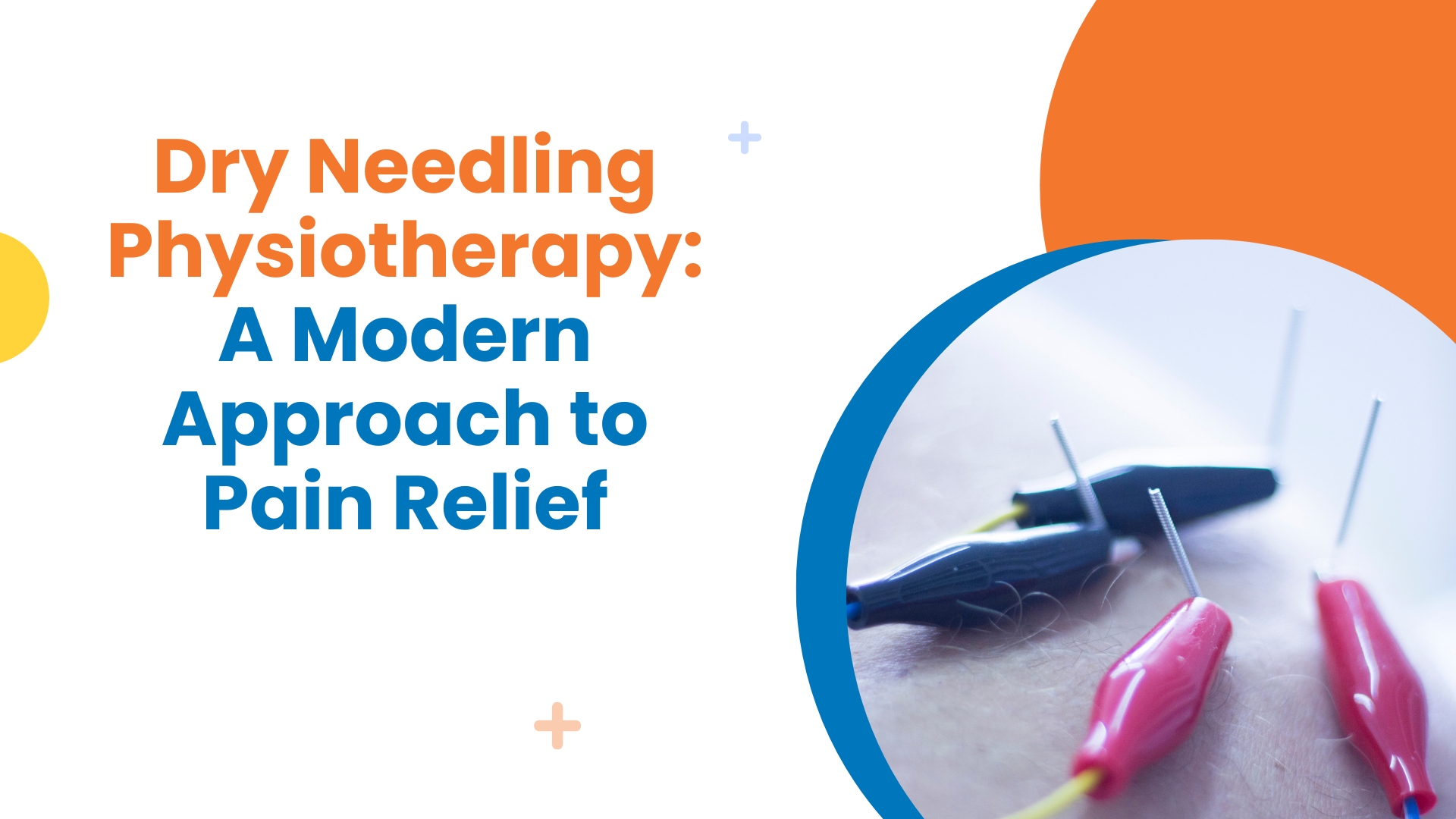 Dry Needling Physiotherapy: A Modern Approach to Pain Relief