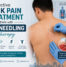 Dry Needling Therapist in Delhi for Back Pain | Physio Revive