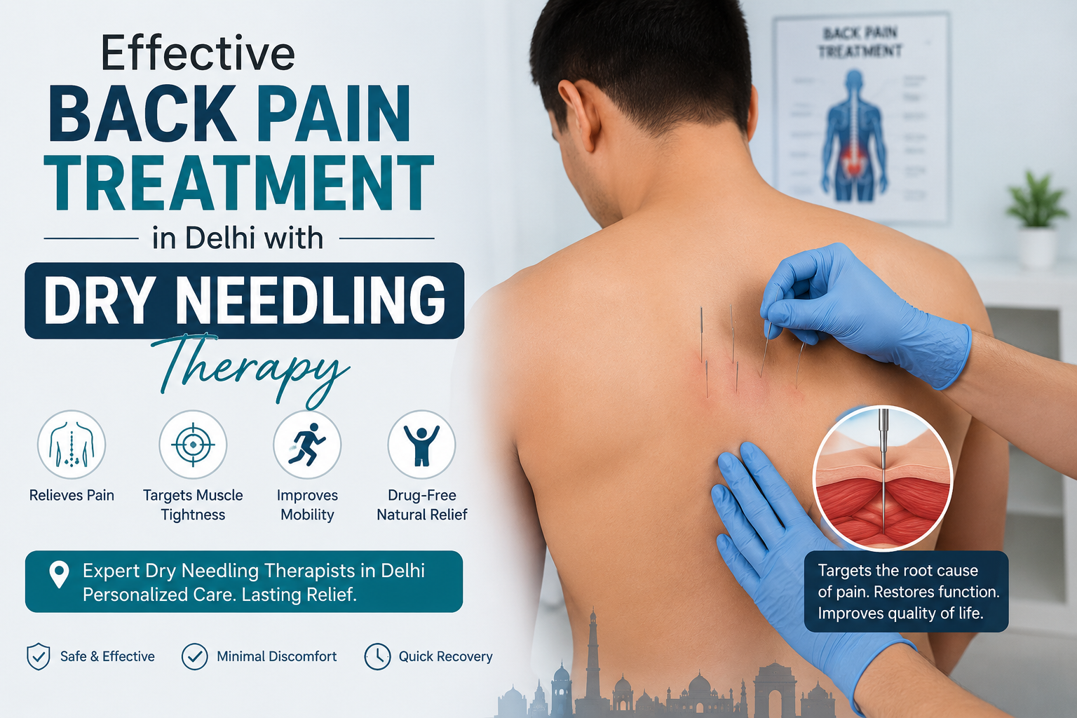 Effective Back Pain Treatment in Delhi with Dry Needling Therapy
